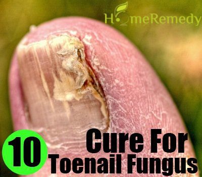 10 Meilleur remède naturel pour mycose des ongles