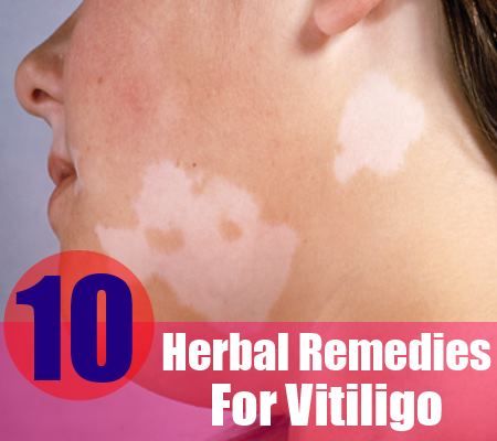 10 remèdes à base de plantes pour le vitiligo