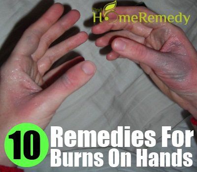 10 Accueil recours pour des brûlures sur les mains