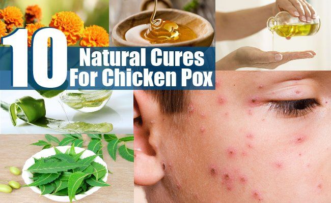 10 Des remèdes naturels pour la varicelle