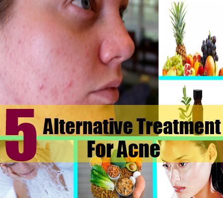 Meilleur traitement alternatif 5 de l'acné