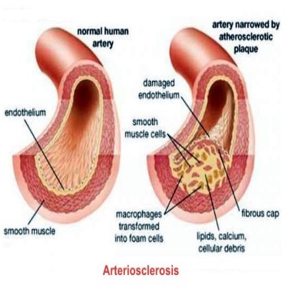 Artériosclérose