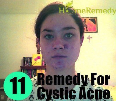 11 Meilleur remède à la maison pour l'acné kystique