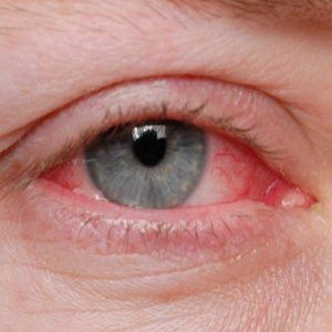 11 Accueil recours pour l'oeil rose ou une conjonctivite