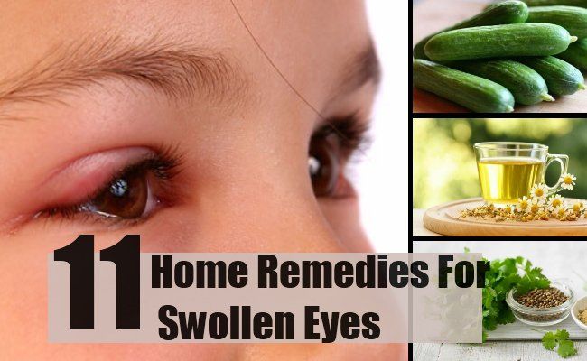 11 remèdes à la maison pour les yeux gonflés