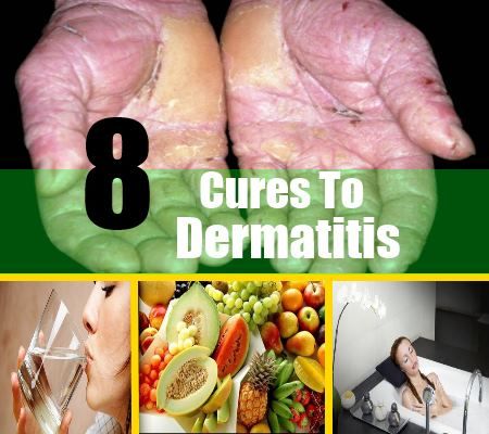 5 remèdes étonnants pour la dermatite