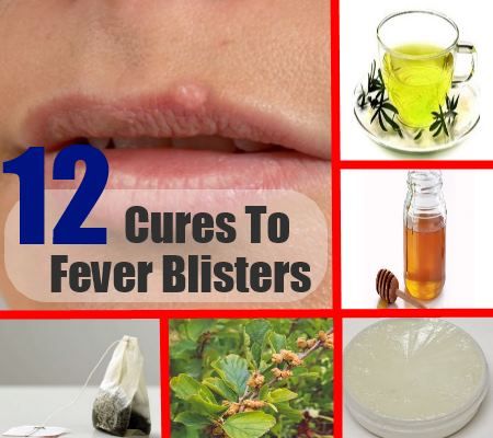 12 remèdes naturels efficaces pour les boutons de fièvre