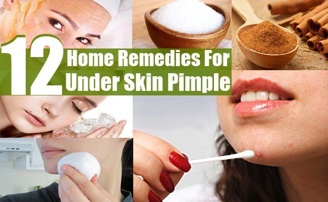 12 remèdes à la maison pour moins de Pimple de la peau