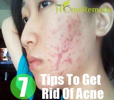 5 façons de se débarrasser de l'acné