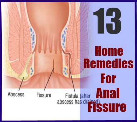 13 Accueil recours pour la fissure anale