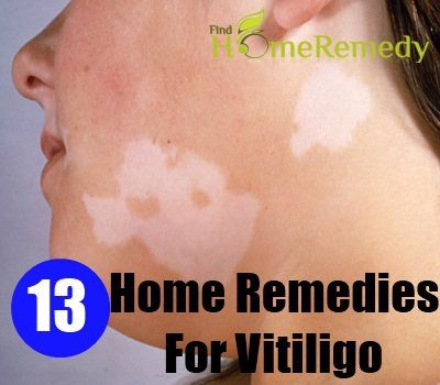 13 remèdes à la maison pour le vitiligo