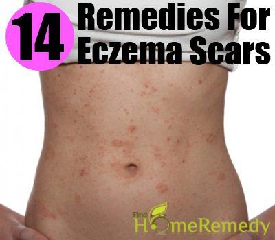 14 remèdes efficaces à domicile pour les cicatrices d'eczéma