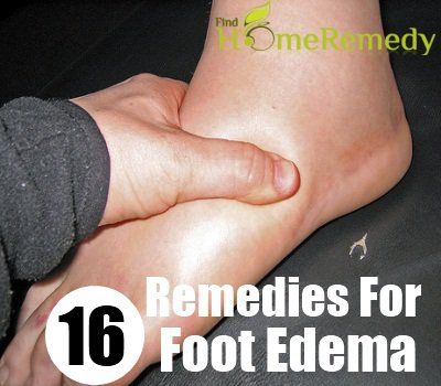 16 excellents remèdes maison pour se débarrasser de pied oedème