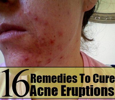 16 Accueil remèdes pour guérir les éruptions d'acné