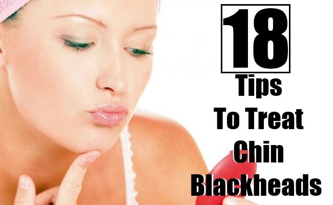 18 Conseils pour traiter les points noirs menton naturellement à la maison