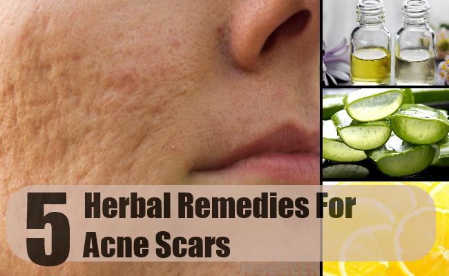 5 meilleurs remèdes pour les cicatrices d'acné