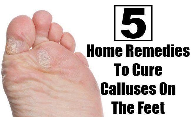 5 meilleurs remèdes maison pour guérir les callosités sur les pieds