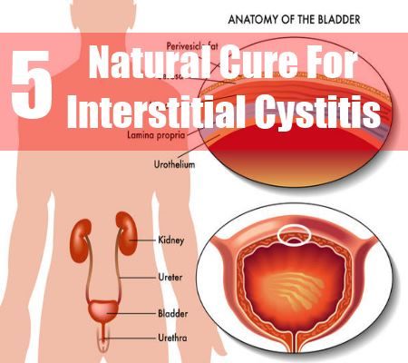 5 Meilleur remède naturel pour la cystite interstitielle