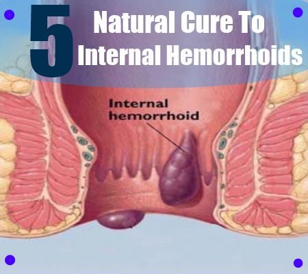 5 Meilleur remède naturel pour les hémorroïdes internes