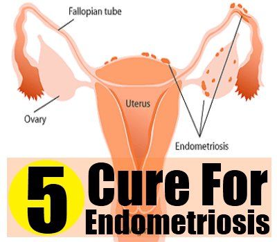 5 remède naturel pour l'endométriose
