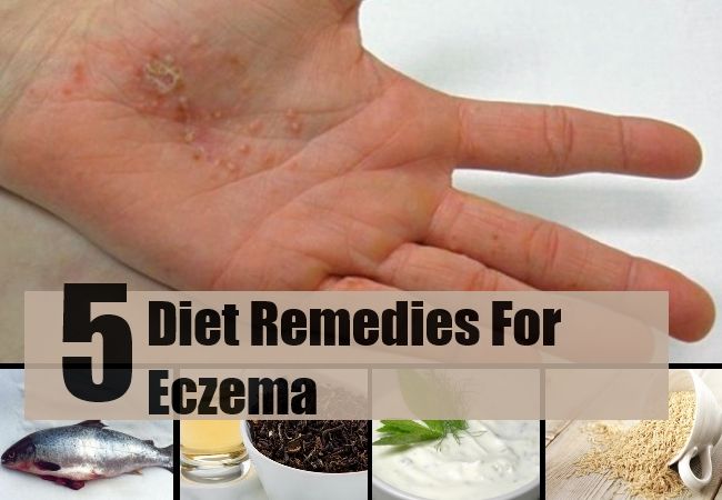 5 remèdes de régime efficace pour l'eczéma