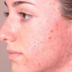 5 remèdes efficaces pour l'acné rouge