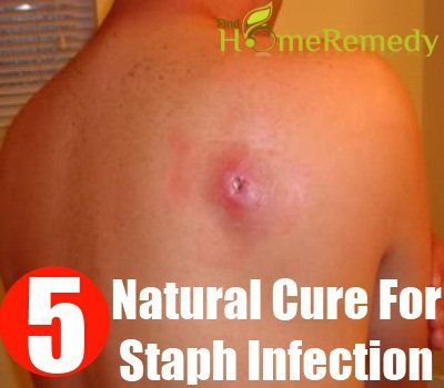 Remède naturel pour infection staphylococcique