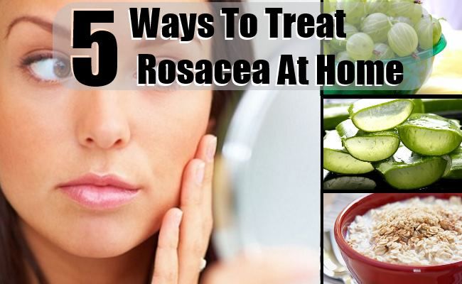 5 moyens efficaces pour traiter la rosacée à la maison