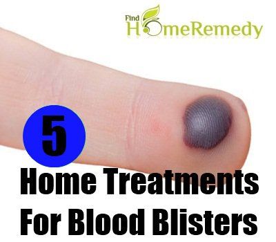 5 excellents traitements à domicile pour les ampoules de sang