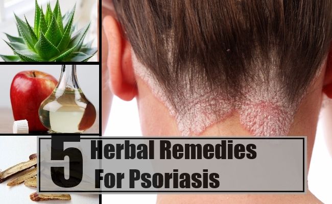 5 remèdes naturels pour le psoriasis
