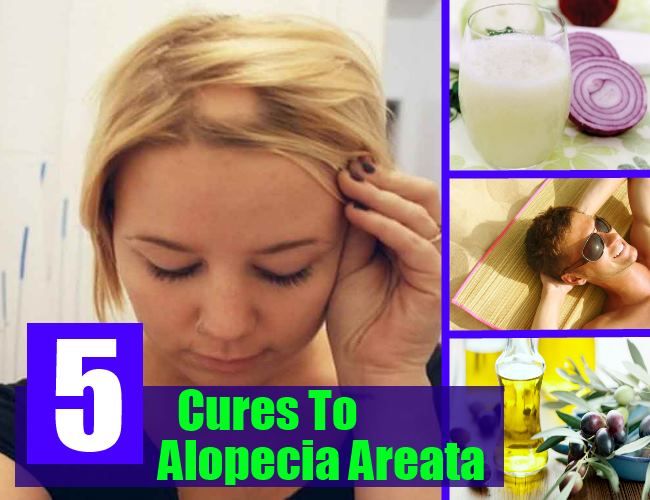 5 Accueil recours pour l'alopécie
