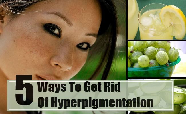 5 façons de se débarrasser de l'hyperpigmentation