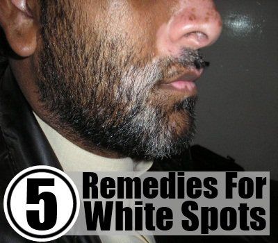 5 remèdes maison pour les taches blanches sur la peau
