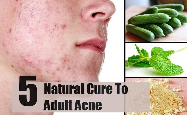 5 remède naturel pour l'acné adulte