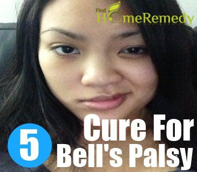 5 remède naturel pour la paralysie de Bell