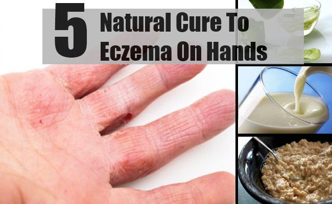 5 remède naturel pour l'eczéma sur les mains