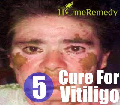5 remède naturel pour le vitiligo