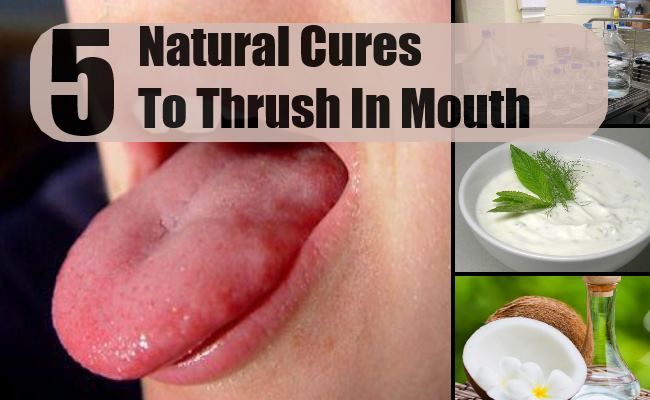 5 remède naturel à la grive dans la bouche