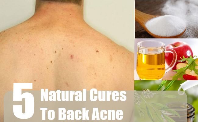 5 remèdes naturels pour l'acné de retour