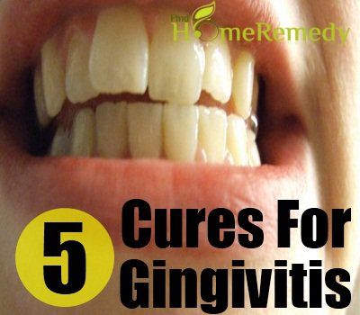 5 remèdes naturels pour la gingivite