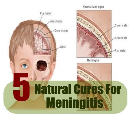 5 remèdes naturels pour la méningite