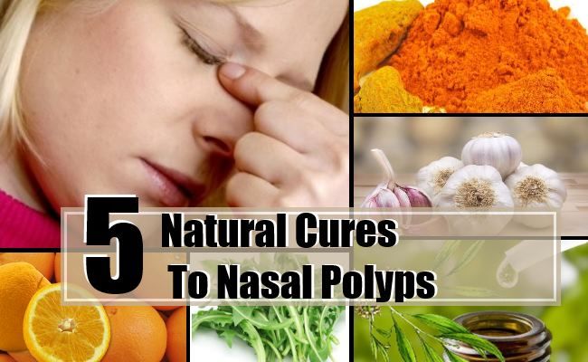 5 remèdes naturels pour les polypes nasaux