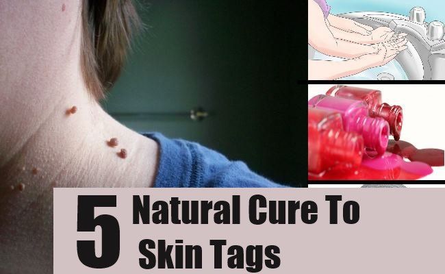 5 remèdes naturels pour les balises de la peau