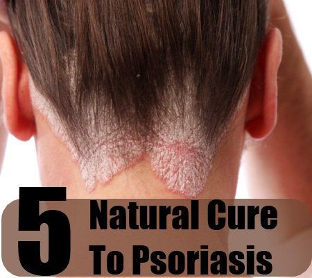 5 remède naturel simple pour le psoriasis