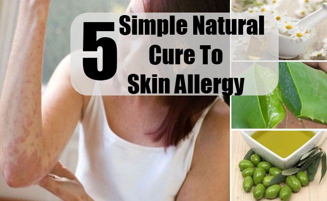 5 remède naturel simple à l'allergie de la peau