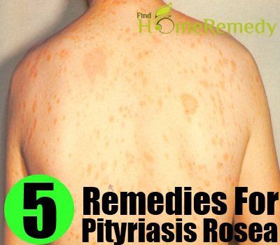 5 Divers remèdes à base de plantes pour le pityriasis rosé