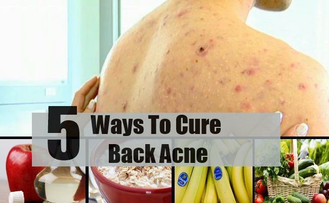 5 façons de guérir l'acné dos