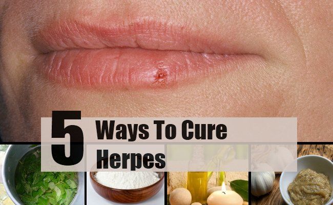 5 façons de guérir l'herpès