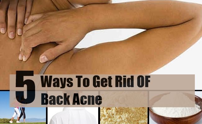 5 façons de se débarrasser de l'acné dos