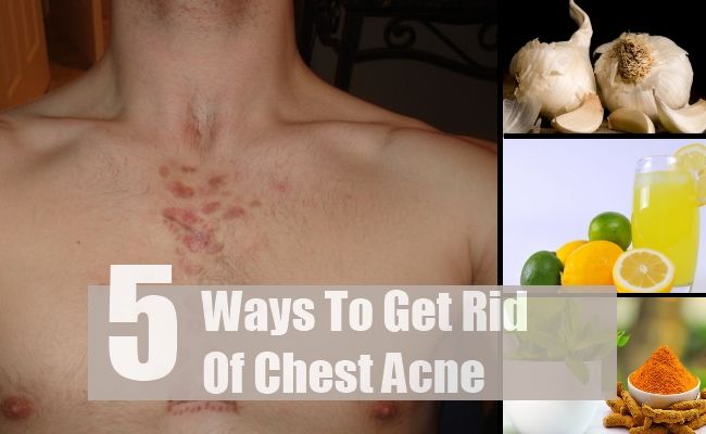5 façons de se débarrasser de l'acné poitrine
